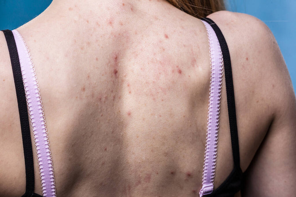Health problem, skin diseases. Young woman showing her back with allergy rash acne - Фото, зображення
