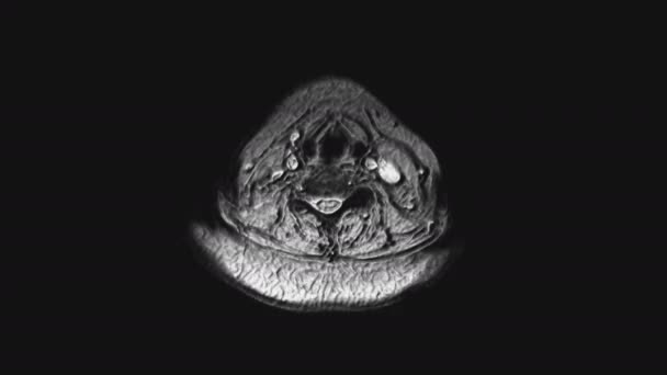 pooperacyjny obszerny rezonans magnetyczny narządów żeńskich w celu wykrycia przerzutów - Materiał filmowy, wideo
