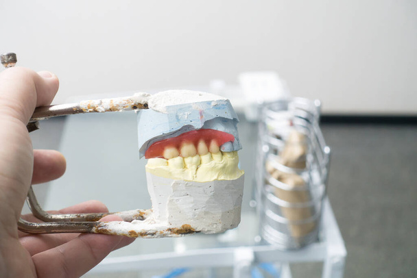 石膏モードでの取り外し可能な入れ歯のワックス調製 - 写真・画像