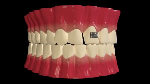 Αυτό το βίντεο δείχνει την εφαρμογή οδοντικών στηριγμάτων για ευθυγράμμιση και ίσιωμα των δοντιών - Πλάνα, βίντεο