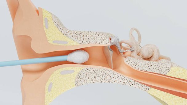 Bâton d'oreille en cire d'oreille nettoyant les oreilles en 3D. Illustration 3d
 - Photo, image
