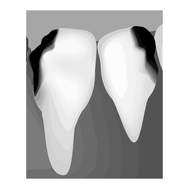 Zahnkaries. Röntgenbild von Karies. Kariesinfografiken. Vektor-Illustration auf isoliertem Hintergrund. - Vektor, Bild