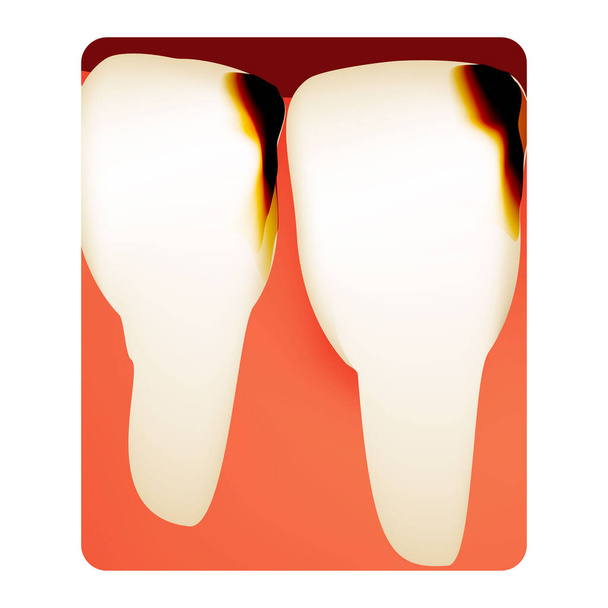 Dental caries. tooth decay. Caries infographics. Vector illustration on isolated background. - Vector, Image