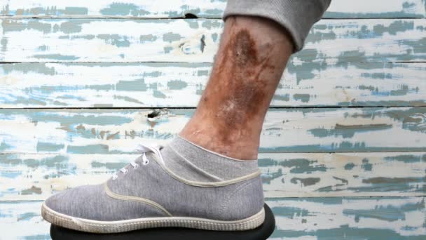 Mauvaise jambe et maladie de la peau humaine. Des cicatrices, des ulcères et des taches de vieillesse, peut-être après des varices à la jambe. Gros plan
. - Séquence, vidéo