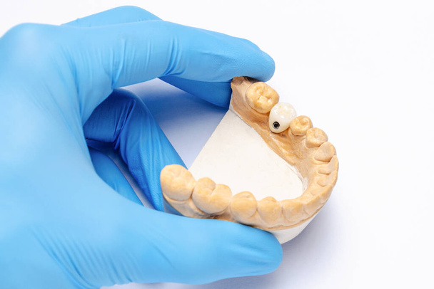 a gloved hand holds a plaster model of the lower jaw with a ceramic crown on a dental implant. concept of prosthetics on dental implants. dental implantation - Photo, Image