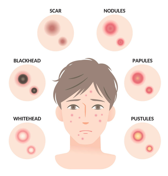 Tipi di acne e l'uomo volto illustrazione. Whitehead, testa nera, papule e pustole. concetto di bellezza cura della pelle degli uomini
 - Vettoriali, immagini