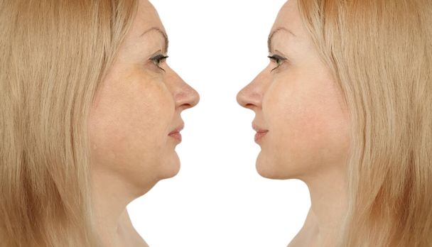 woman double chin before and after treatment - Photo, Image