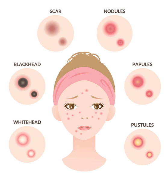 Typen von Akne und Frauen Gesicht Illustration. Weißkopf, schwarzer Kopf, Papeln und Pusteln. Schönheitspflegekonzept - Vektor, Bild