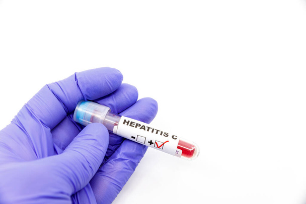 Mikrobiologin tai lääketieteellisen työntekijän käden lähikuva sinisillä leikkauskäsineillä, joiden mukaan verikokeen tulos on positiivinen C-hepatiitin kannalta.
 - Valokuva, kuva