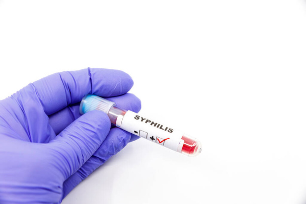 Gros plan de la main du microbiologiste ou du travailleur médical avec des gants chirurgicaux bleus marquant le résultat du test sanguin comme positif pour la syphilis. Syphilis Concept positif
 - Photo, image