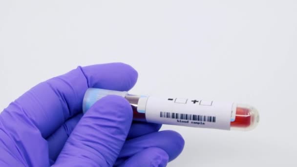 Closeup of microbiologist or medical worker hand with blue surgical gloves marking blood test result as positive for the rapidly spreading mumps. Mumps Positive concept - Footage, Video