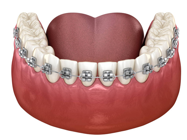 Dientes sanos con tirantes de metal, vista Macro. Ilustración dental 3D médicamente precisa - Foto, Imagen