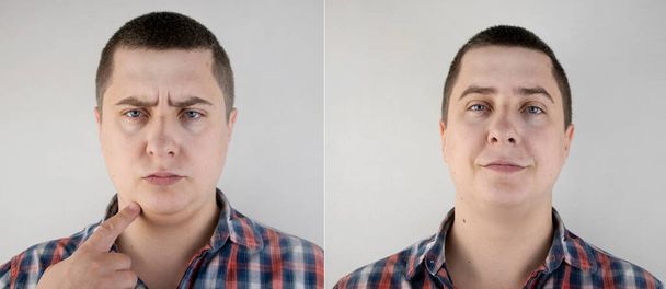 Ο άνθρωπος έχει και δεύτερο πηγούνι. Φωτογραφίες πριν και μετά την πλαστική χειρουργική του προσώπου. Κοντινό πλάνο του λυπημένου προσώπου ενός ασθενούς και το λίπος του στο λαιμό του. - Φωτογραφία, εικόνα