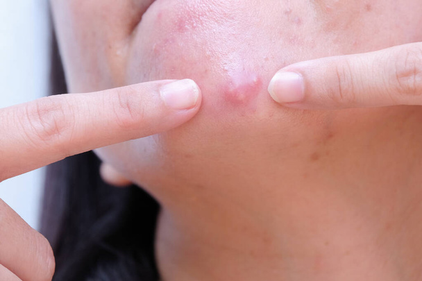 Woman squeezing acne on her face - Foto, imagen