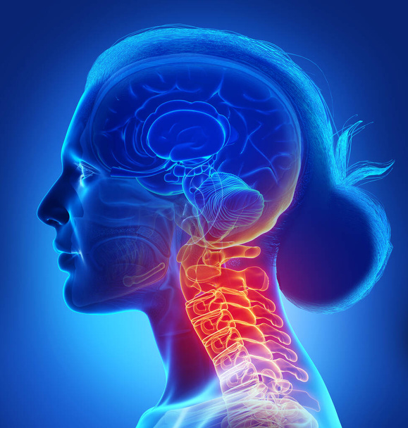 3Dレンダリング、痛みを伴う首を持つ女性の医学的に正確なイラスト - 写真・画像