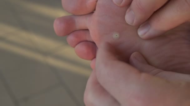 Un primo piano del piede di un verrucoso caucasico. Le dita della mano ispezionare la pelle vicino alla zona infetta
. - Filmati, video