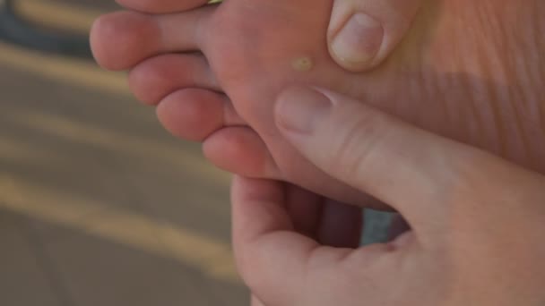 Un primo piano del piede di un verrucoso caucasico. Le dita della mano ispezionare la pelle vicino alla zona infetta
. - Filmati, video