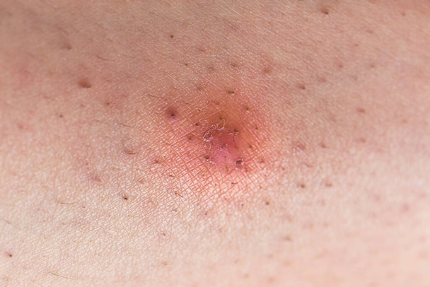 Close-up van de blanke huid met ingegroeide haren - Foto, afbeelding