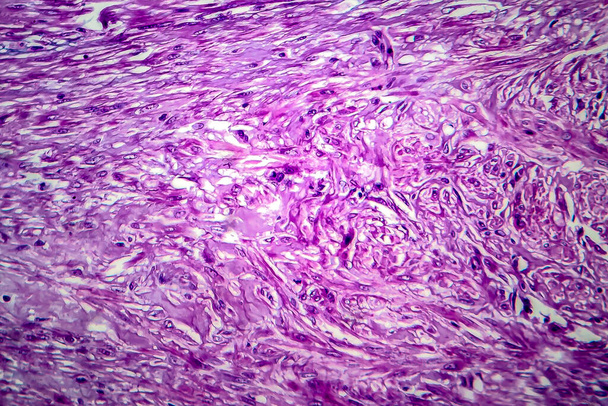 Лейоміома яєчників, також відома як фіброїди, доброякісна пухлина гладких м'язів матки, легкий мікрограф, фото під мікроскопом
 - Фото, зображення