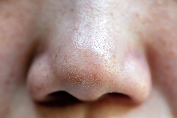 Boutons et pores dans le nez des Asiatiques - Photo, image