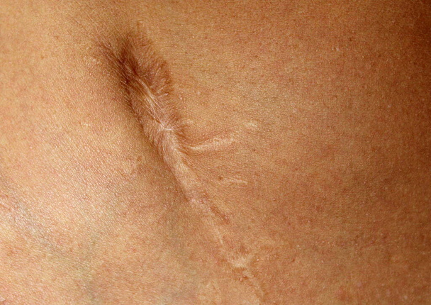 Klein litteken na blindedarmontsteking. Fragment van het lichaam van een man met een litteken. - Foto, afbeelding
