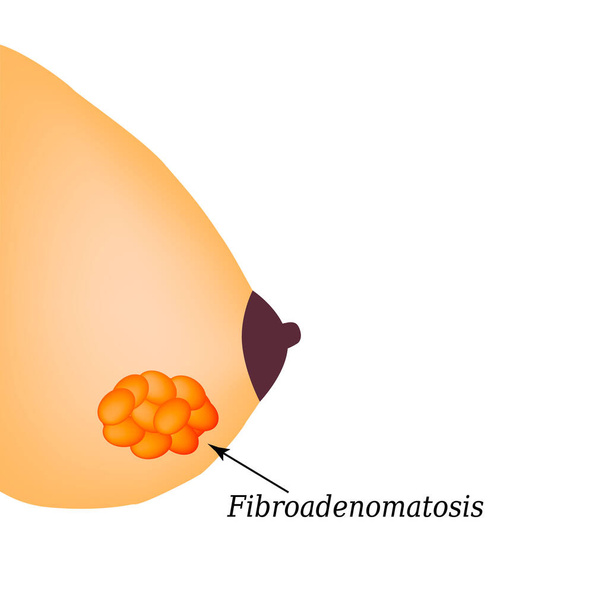 Fibroadenomatose in der Brustdrüse. Weltbrustkrebstag. Vektor-Illustration auf isoliertem Hintergrund - Vektor, Bild