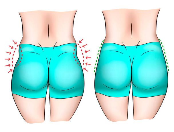 Comparison of love handles on a woman body - Vector, Image