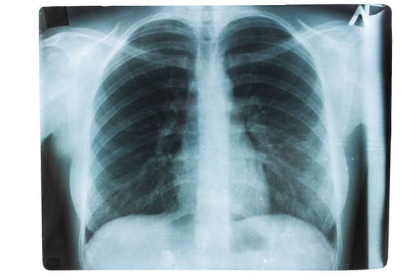 Prześwietlenie zdrowych płuc. Kości ludzkie - Zdjęcie, obraz