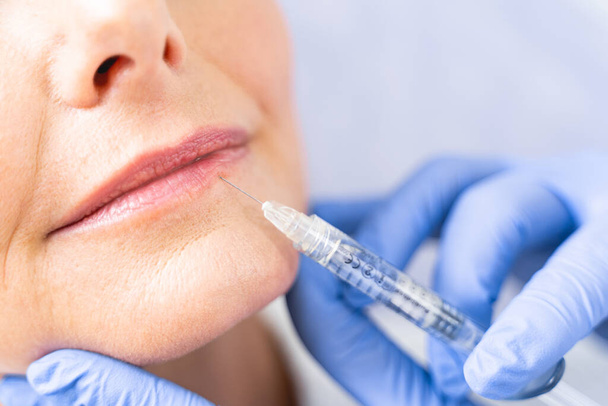 Patient receiving a micro-injection in the bottom lip - Foto, Imagem