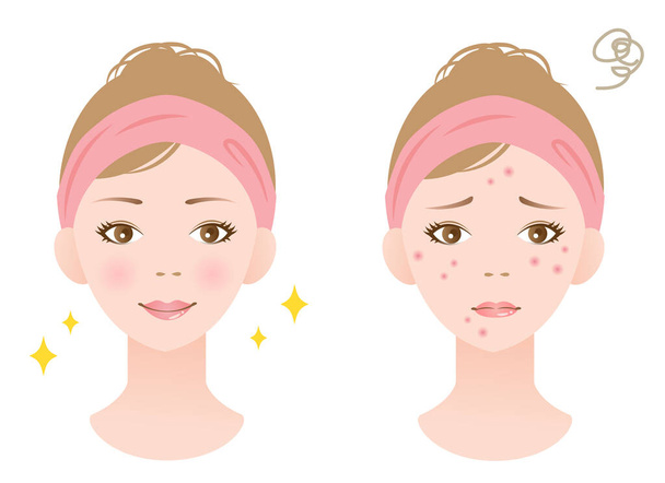 πρόσωπο γυναίκα πριν και μετά από τη διαδικασία θεραπείας ακμής. Έννοια φροντίδας δέρματος - Διάνυσμα, εικόνα