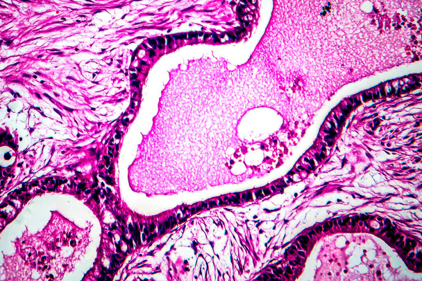 子宮がん、軽いマイクログラフ、顕微鏡下の写真 - 写真・画像
