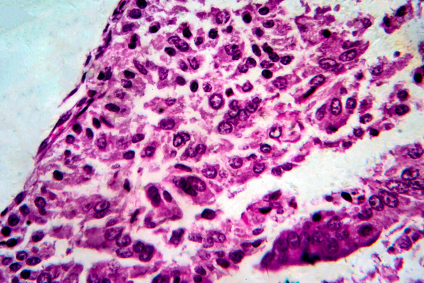Endometriumadenocarcinoom, lichtmicrograaf, foto onder microscoop - Foto, afbeelding