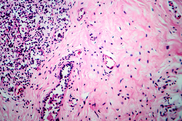 Fibroadenosis de peito, micrografia de luz, foto sob microscópio. Processo hiperplásico benigno comum que envolve glândulas mamárias
 - Foto, Imagem