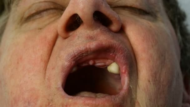 El dentista en guantes quirúrgicos protectores usando instrumentos examina la boca abierta sin dientes con dos dientes del paciente masculino. Primer plano
. - Imágenes, Vídeo