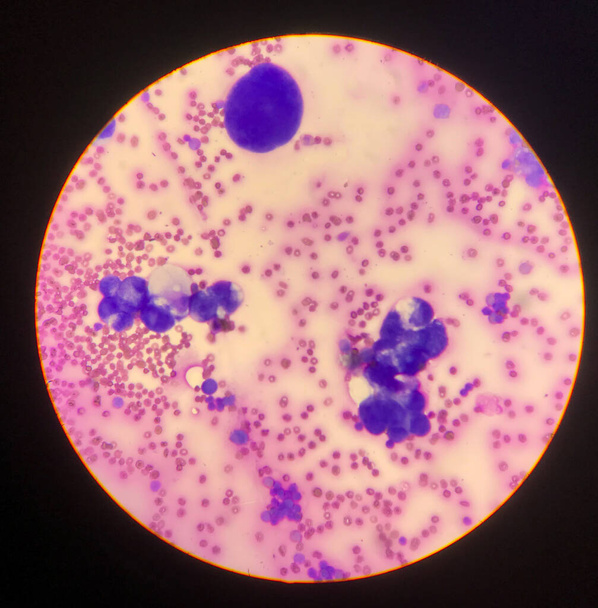 Atypical cells in body fluid smear.Laboratory science concept. - Photo, Image