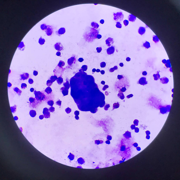 Epätyypillisiä soluja kehon nesteen smear.Laboratory tieteen käsite
. - Valokuva, kuva