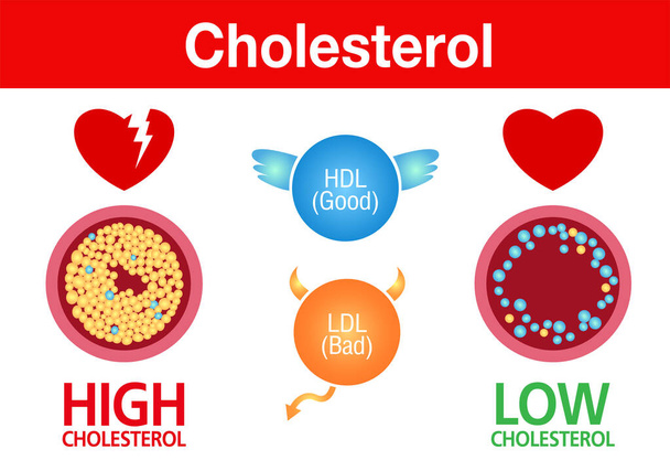 Cholestérol dans l'artère, risque pour la santé, exercice, conception vectorielle
 - Vecteur, image
