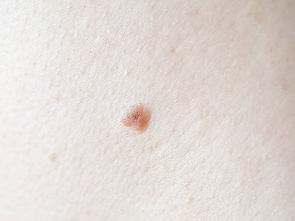 Lunares benignos en la piel humana, de cerca
 - Foto, Imagen