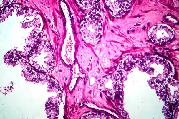 Prostaatkanker, lichtmicrograaf, foto onder microscoop - Foto, afbeelding