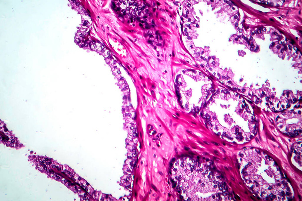 Prostatakrebs, Lichtmikroskopie, Foto unter dem Mikroskop - Foto, Bild