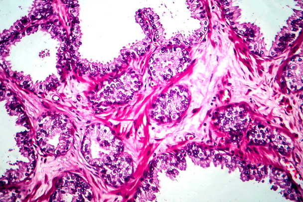前立腺癌,光マイクログラフ,顕微鏡下の写真 - 写真・画像