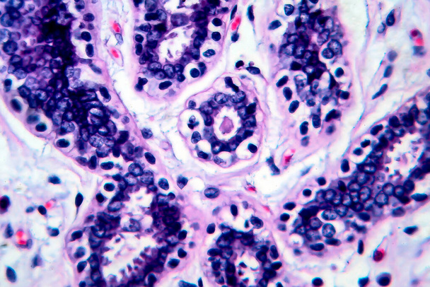 Borstkanker, lichtmicrograaf, foto onder microscoop - Foto, afbeelding