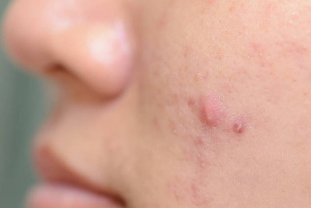 jong Azië vrouw tonen haar gezicht met acne en mollen - Foto, afbeelding