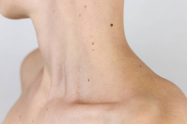 neck, shoulder and collarbone of a young girl with a lot of moles, concept of skin care, beauty and cancer risks due to papillomavirus - Photo, Image