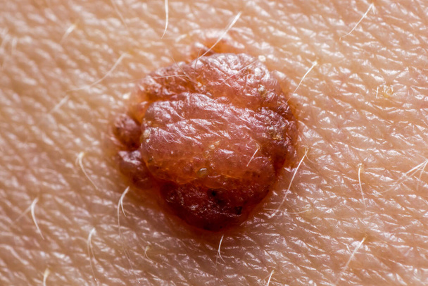 papilloom moedervlek op de menselijke huid, macro shot, concept van gezondheid, huidverzorging en risico op kanker - Foto, afbeelding