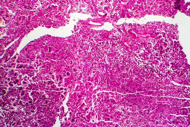 Rak nerki, mikrograf świetlny, zdjęcie pod mikroskopem - Zdjęcie, obraz