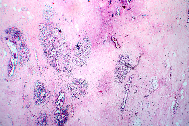 Brustfibrose, Lichtmikroskopie, Foto unter dem Mikroskop. Häufiger gutartiger hyperplastischer Prozess mit Brustdrüsen - Foto, Bild