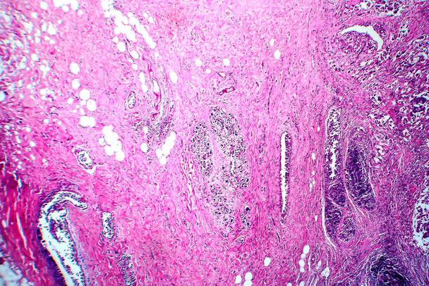 Borstductaal carcinoom, licht micrograaf, foto onder microscoop - Foto, afbeelding