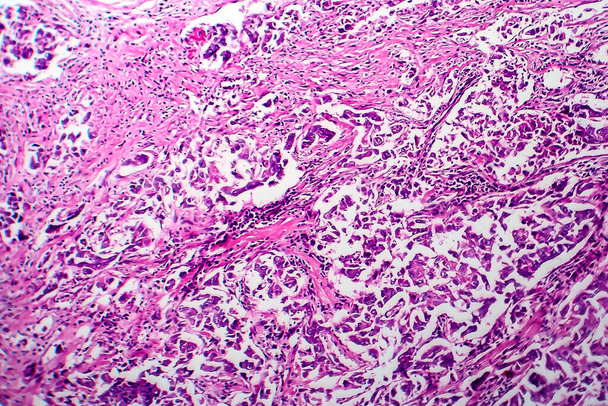 Carcinoma ductal de mama, micrografia de luz, foto sob microscópio
 - Foto, Imagem