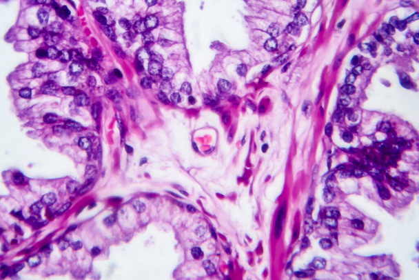 Prostaatkanker, lichtmicrograaf, foto onder microscoop - Foto, afbeelding